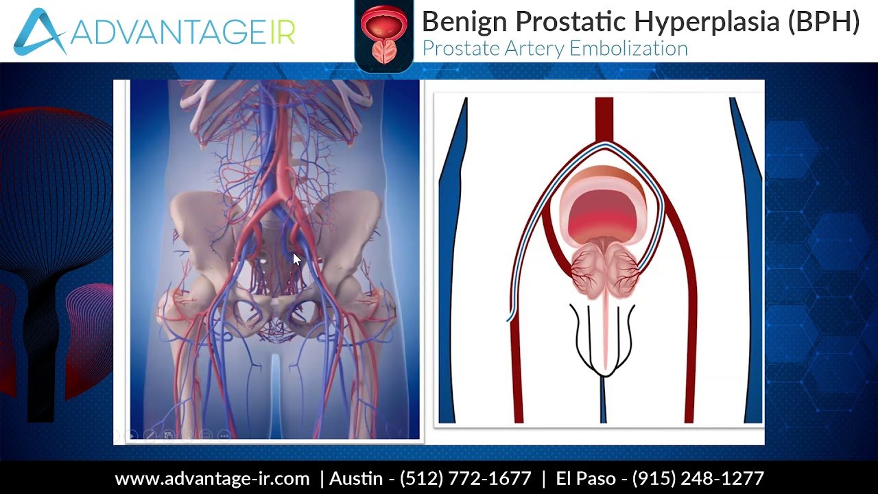 Prostate Artery Embolization (PAE) Explained