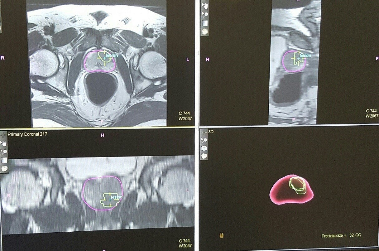 Prostate Biopsy (TRUS or MRI