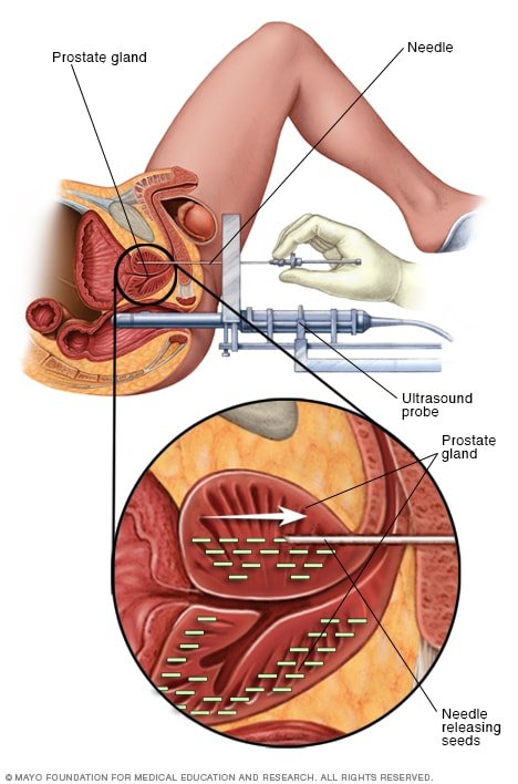 Prostate brachytherapy