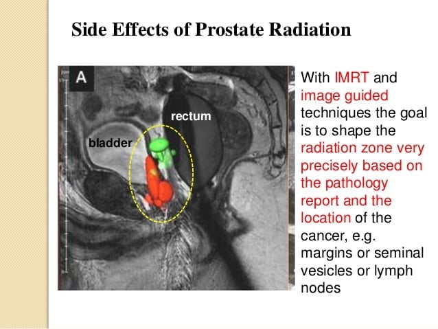 Prostate Cancer and the Role of PostOp Radiation