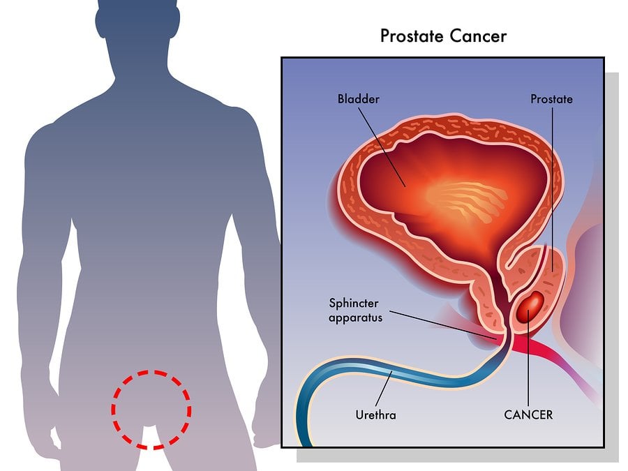 prostate cancer Archives