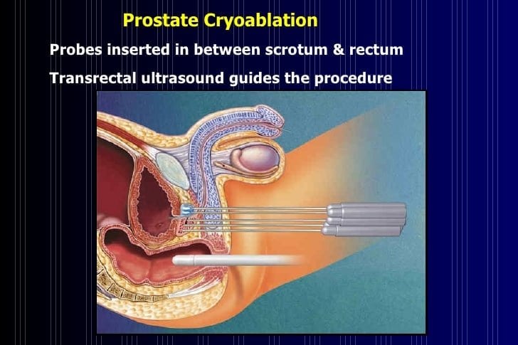 Prostate Cancer: Causes, Diagnosis, and Treatment Options ...