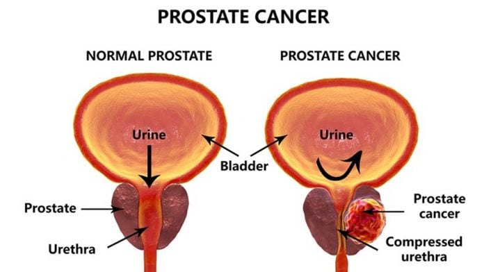 Prostate cancer: Early detection can save lives