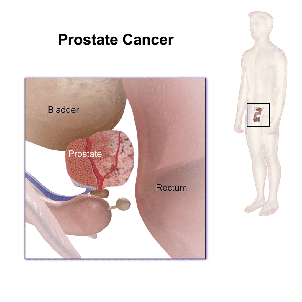 Prostate Cancer: Everything To Know, New Treatment in 2022