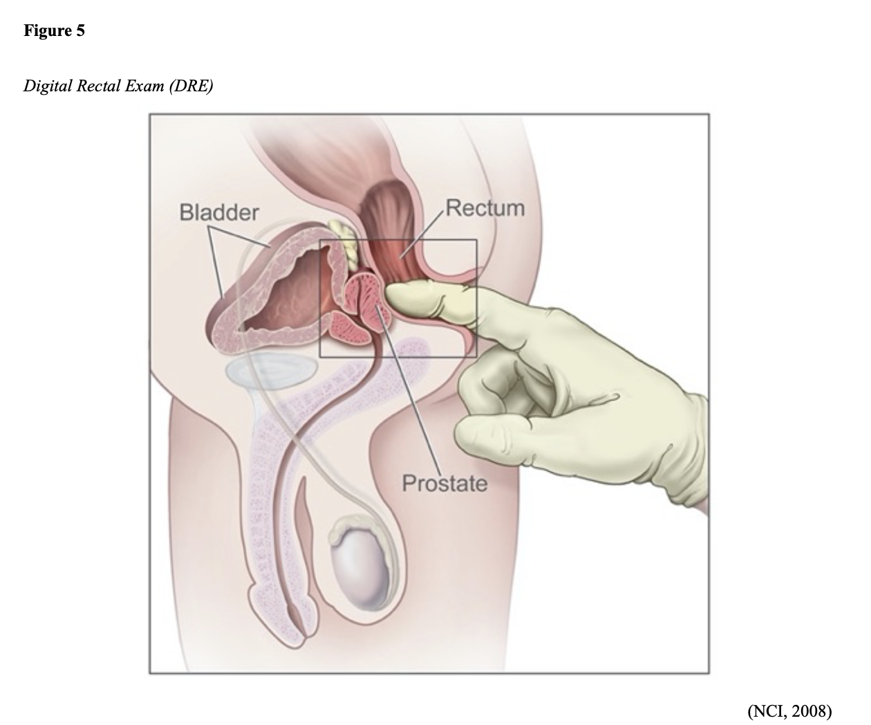 Prostate Cancer for RNs and LPNs Nursing CE Course