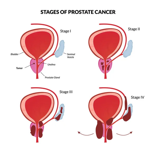 Prostate cancer metastasis â Stock Vector Â© natsuk77 #9627572