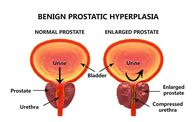Prostate Cancer Overview: Signs, Symptoms, Screening, and ...