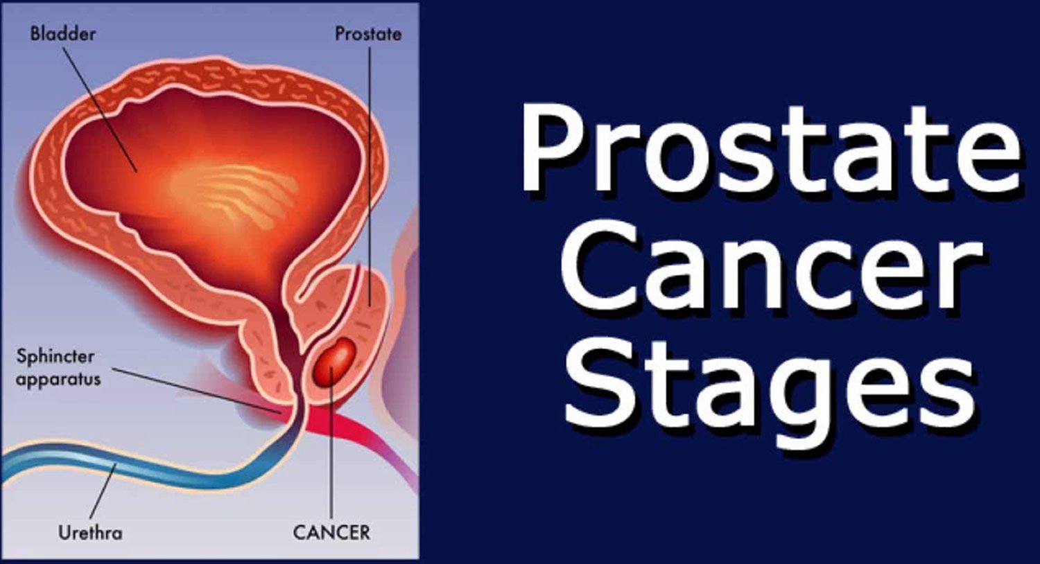 Prostate Cancer Signs and Symptoms. Diagnosis, Stages &  Treatment