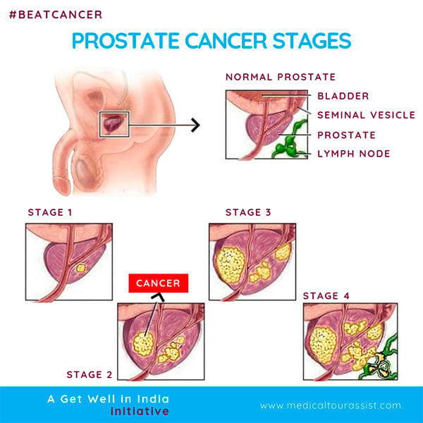 Prostate Cancer treatment