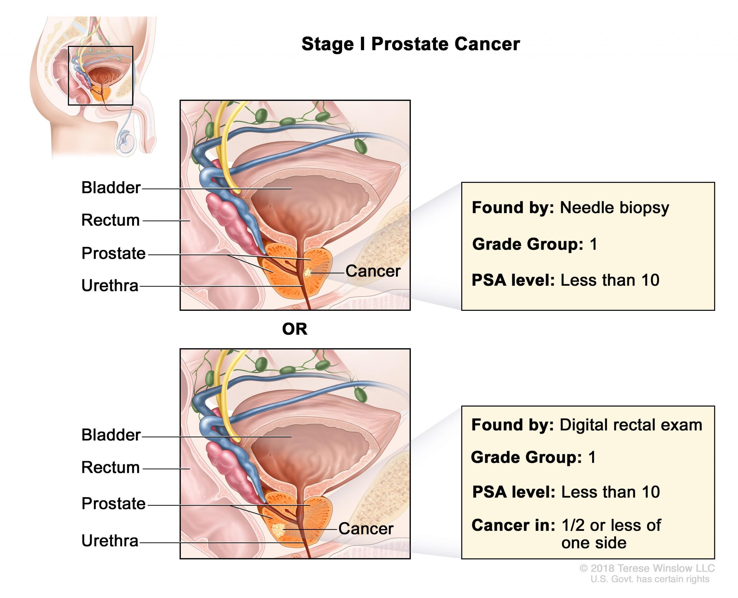 Prostate Cancer Treatment Pdq Health Professional Version