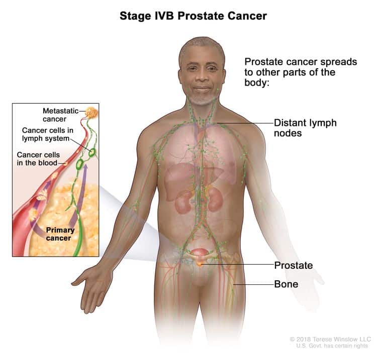 Prostate Cancer Treatment (PDQ®)Health Professional Version