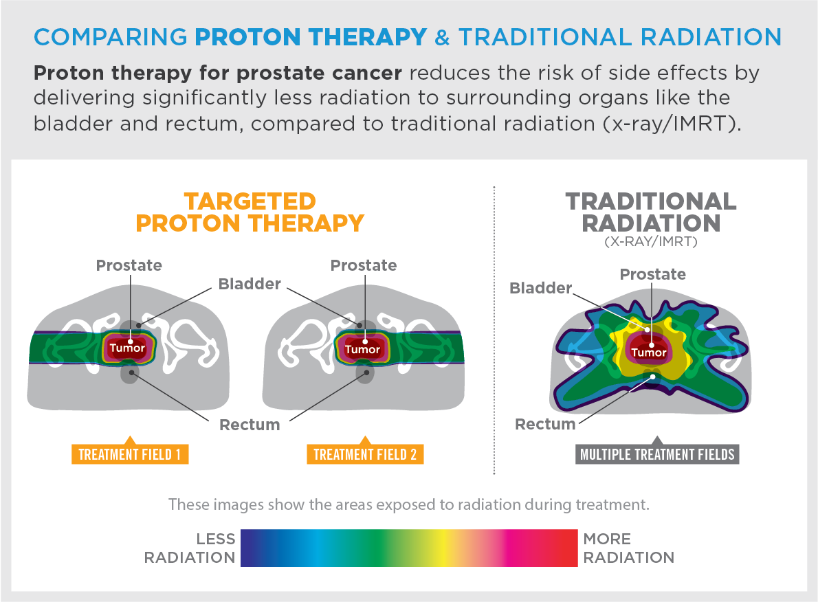 Prostate Cancer Treatment  Provision CARES Proton Therapy Knoxville