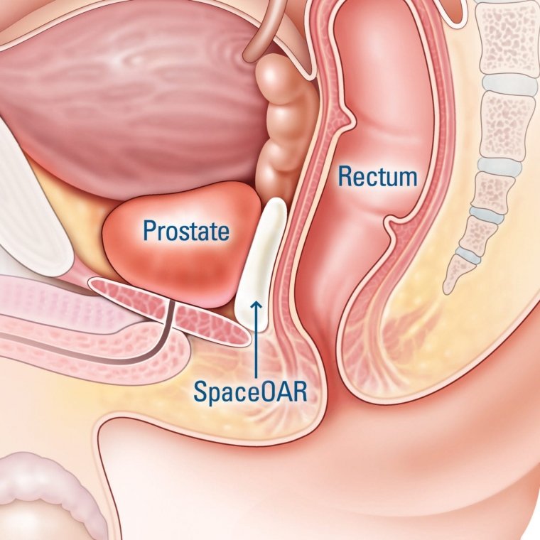 Prostate cancer trial offers hope for faster treatment
