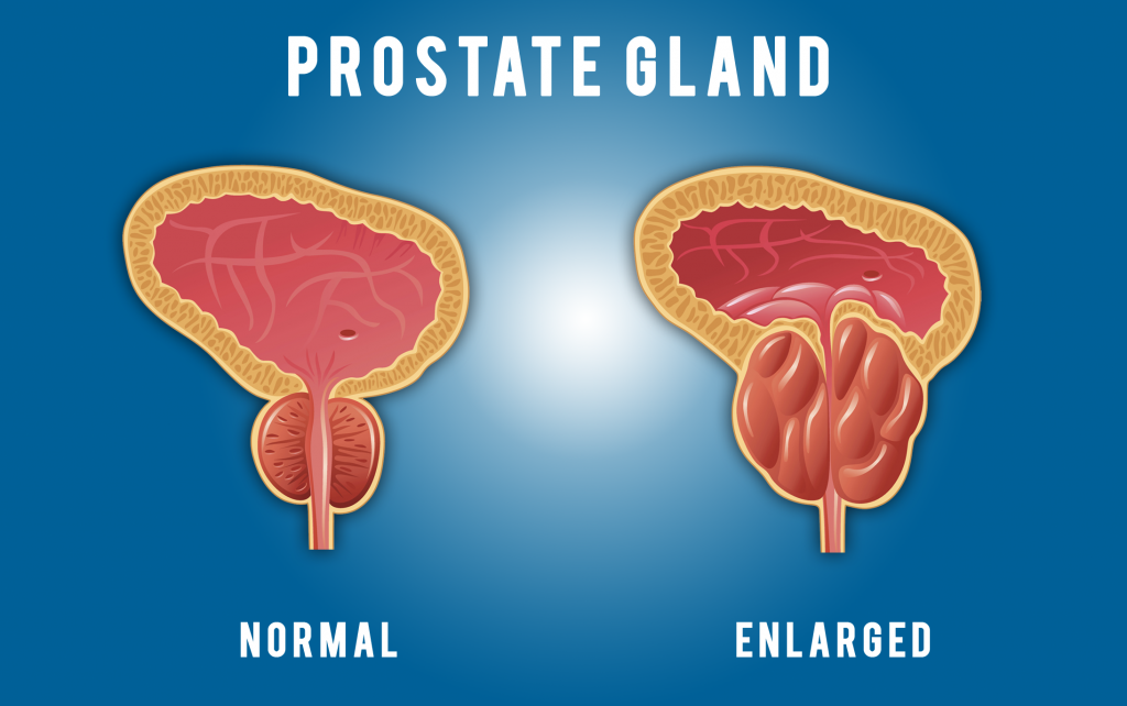 Prostate &  Prostate Signs