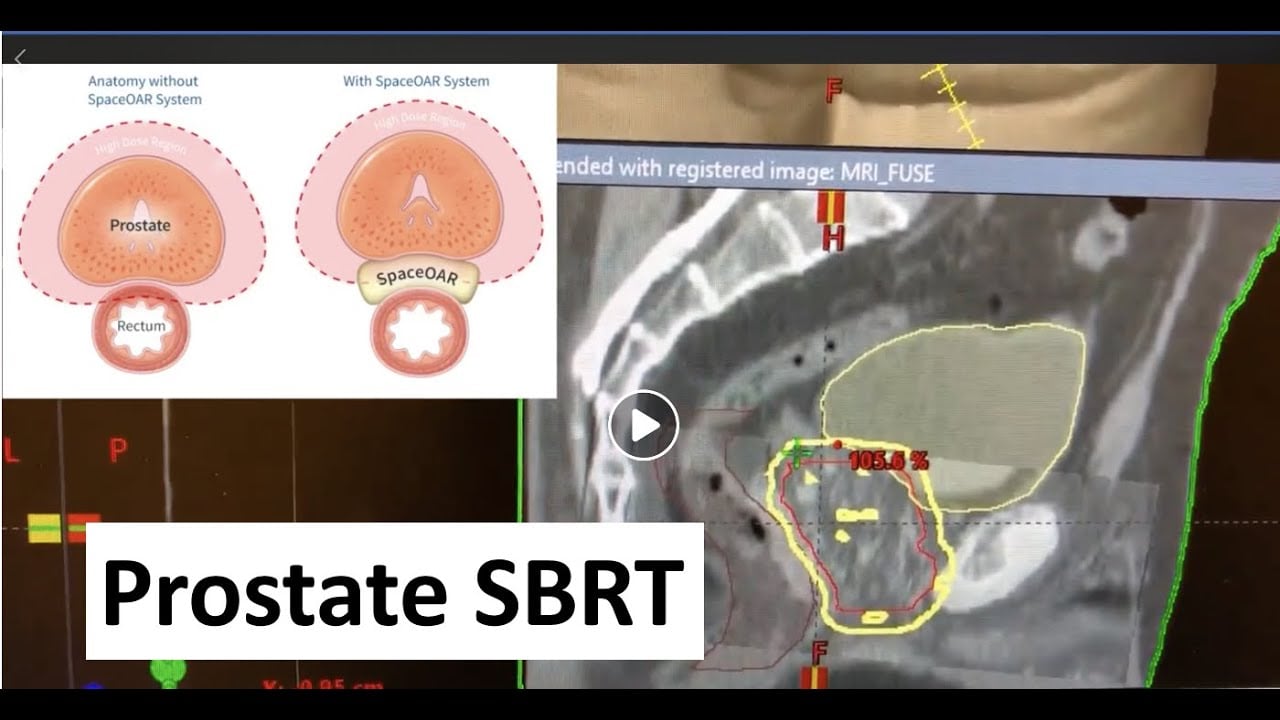 Prostate Stereotactic Body Radiation Therapy (SBRT)