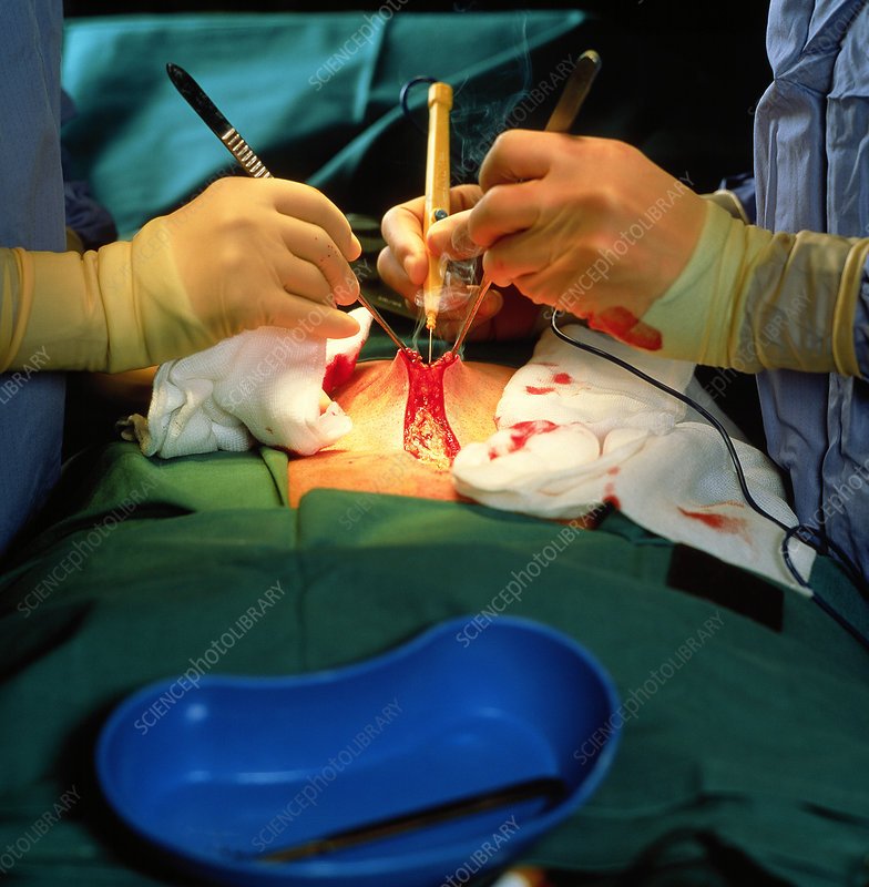 Prostate surgery