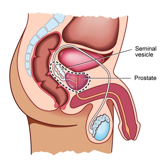 Prostatectomy in Iran at Erfan Hospital