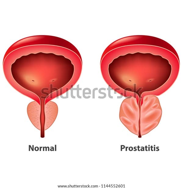 Prostatitis Normal Inflamed Prostate Isolated Vector Stock Vector ...