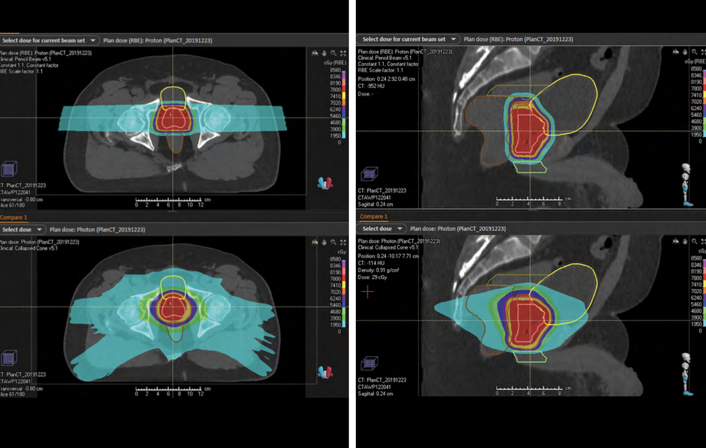 Proton Therapy Case Study  Prostate Cancer
