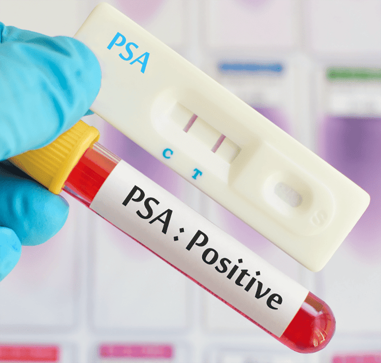 PSA Prostate testing image