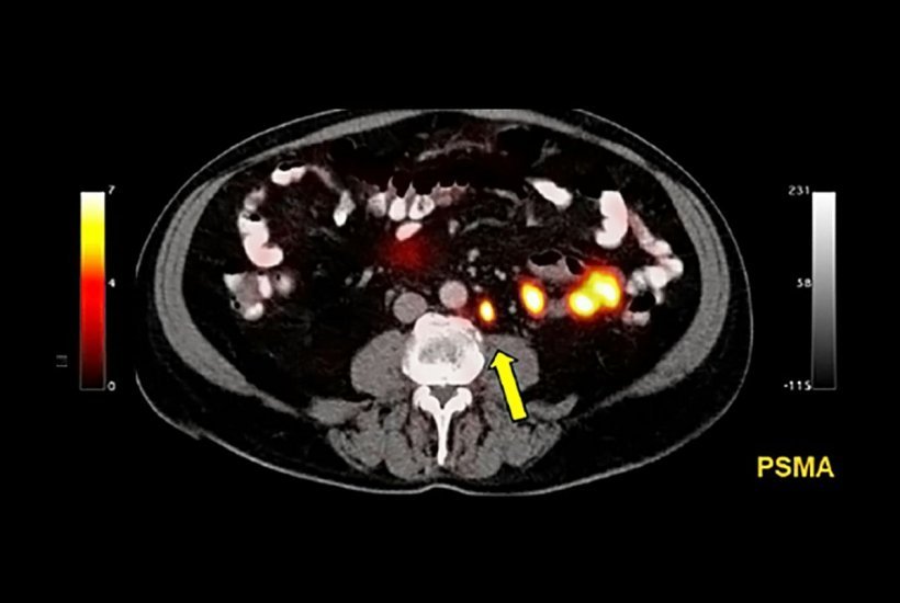 PSMA PET/CT beats standard scan at prostate cancer detecting