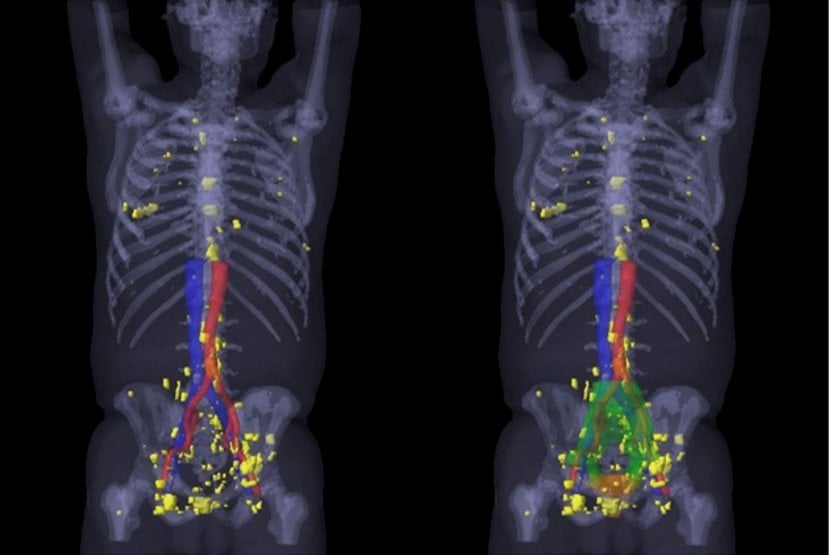 PSMA PET/CT visualizes prostate cancer recurrence early, impacts ...