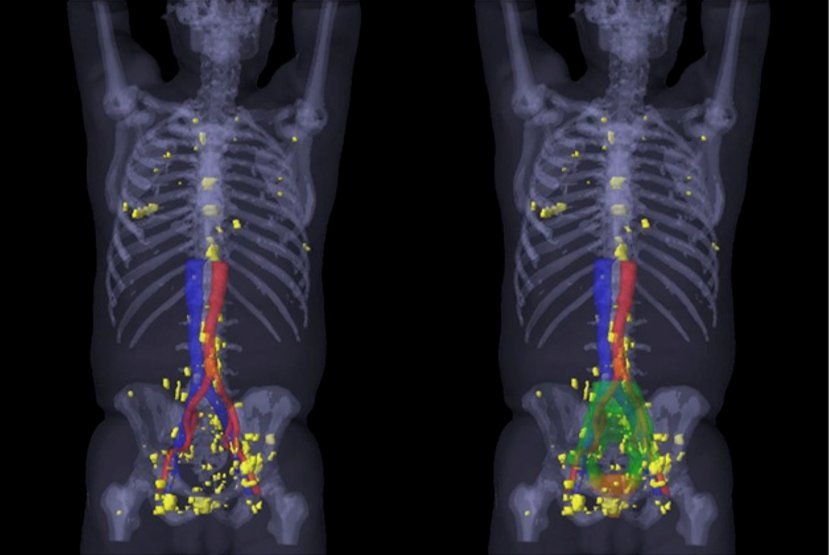 PSMA PET/CT visualizes prostate cancer recurrence early ...
