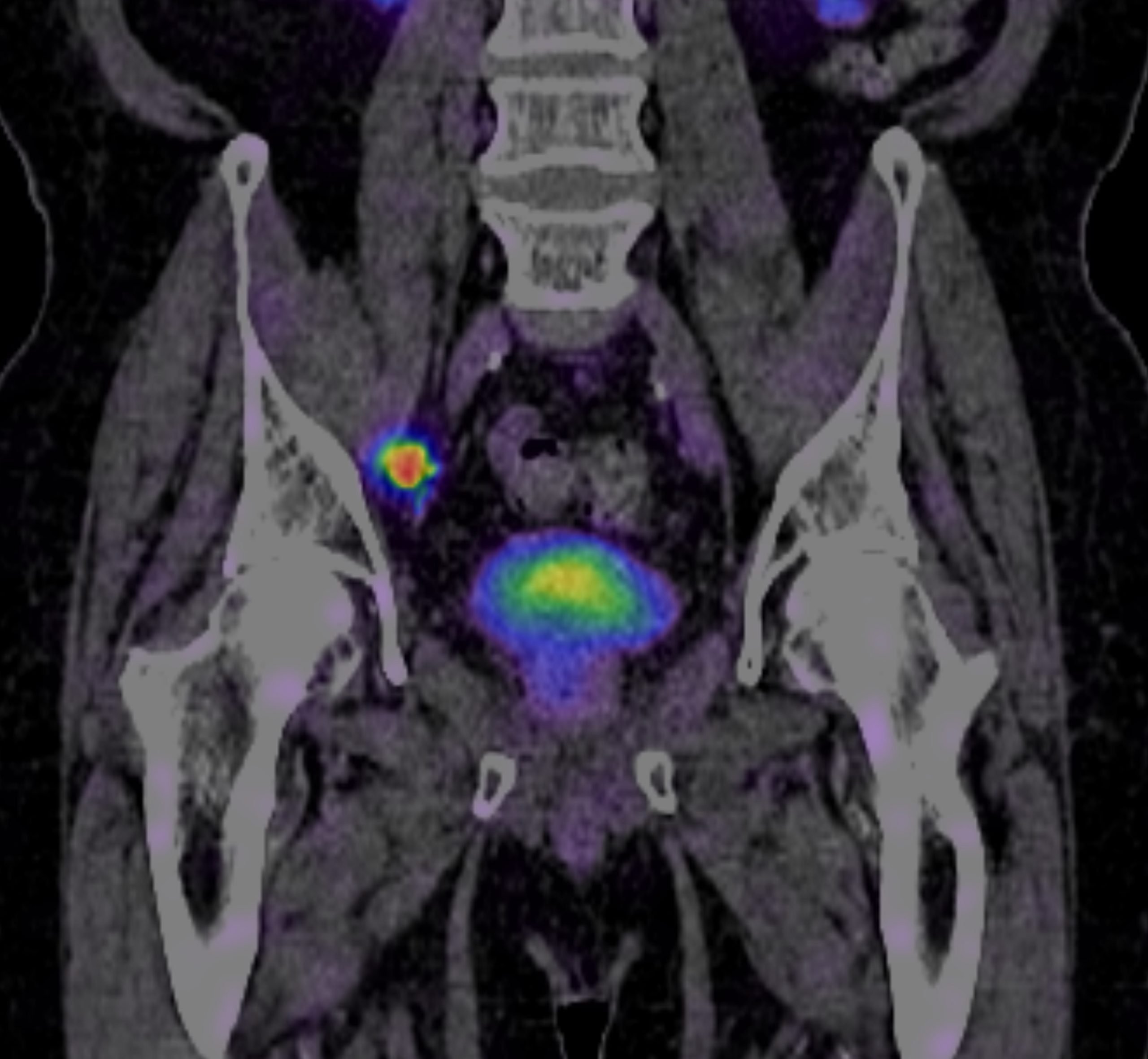 PSMA Scan for prostate cancer
