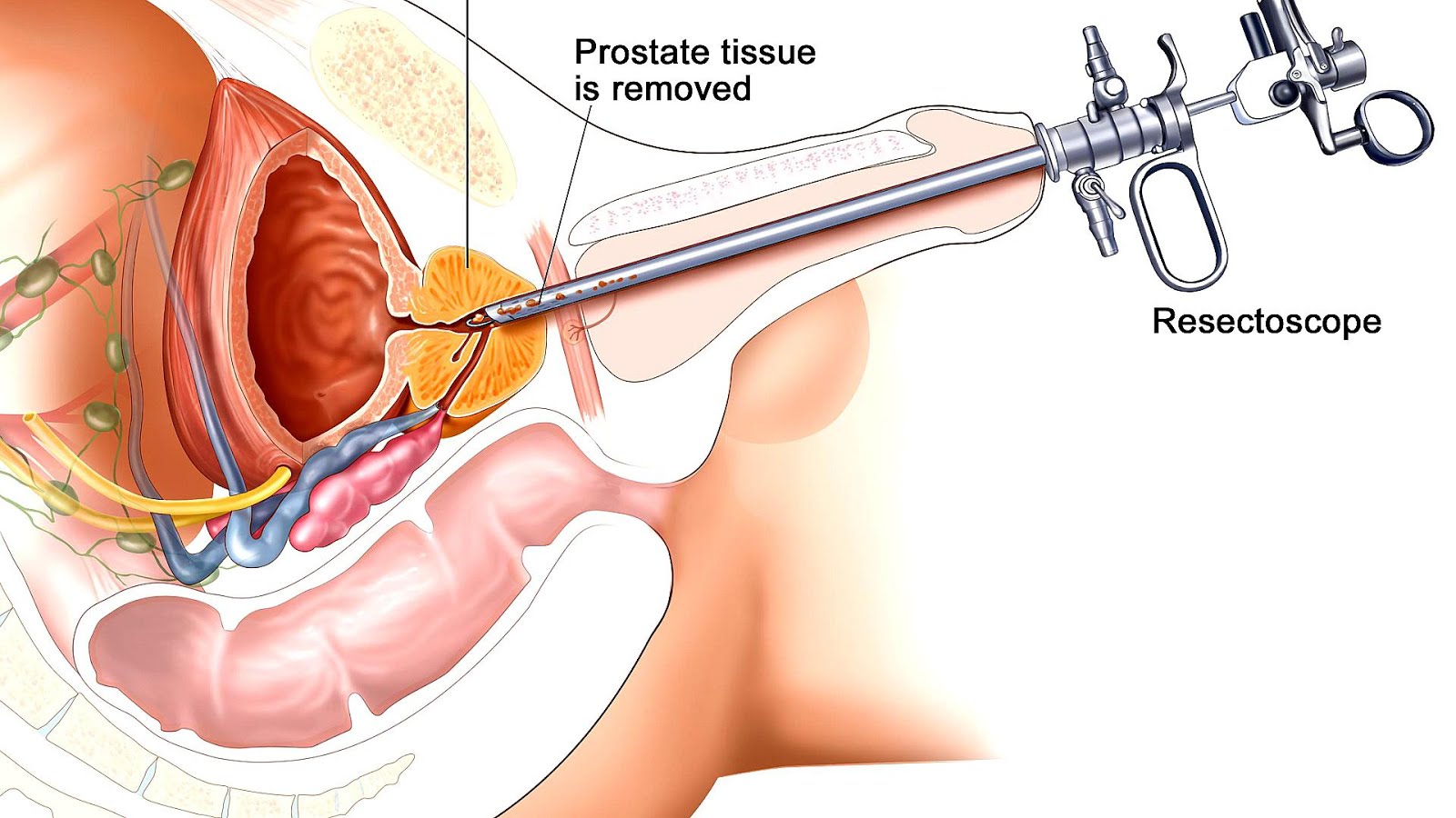 Radiation Therapy Side Effects Prostate Cancer