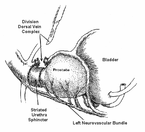Radical Retropubic Prostatectomy illustrated, figure 3, from Dr ...