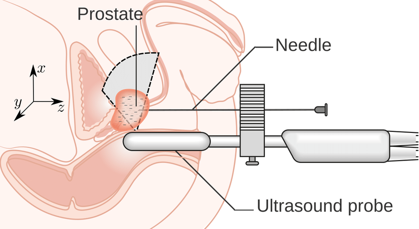 Schematic representation of a typical brachytherapy ...