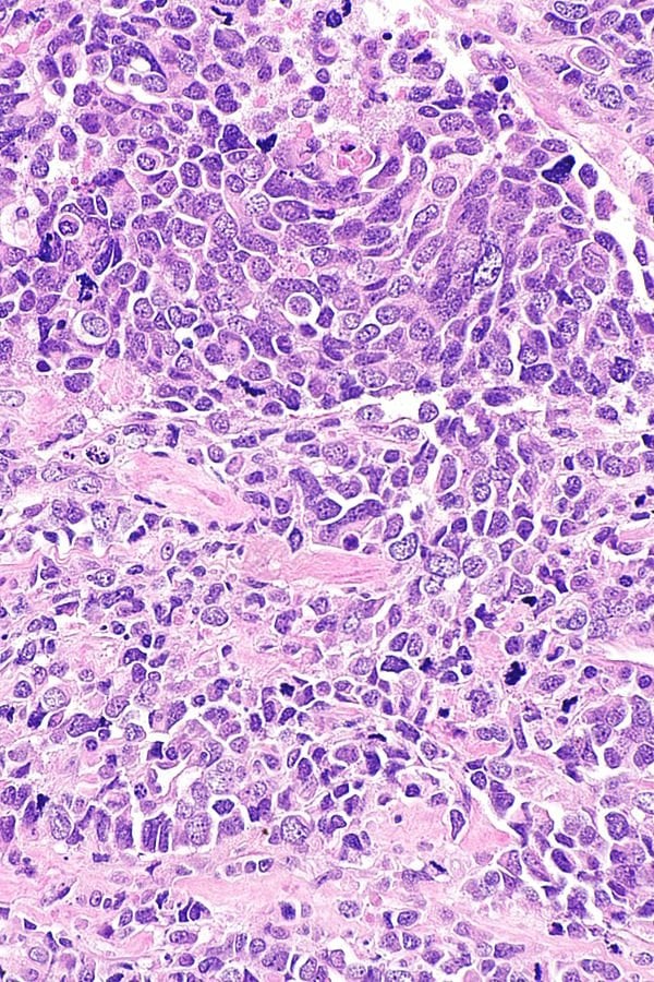 Small cell carcinoma of the prostate gland