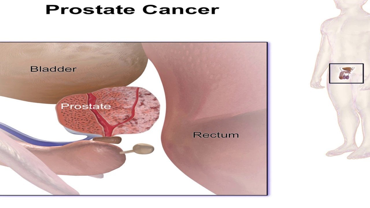 Stage 4 Prostate Cancer