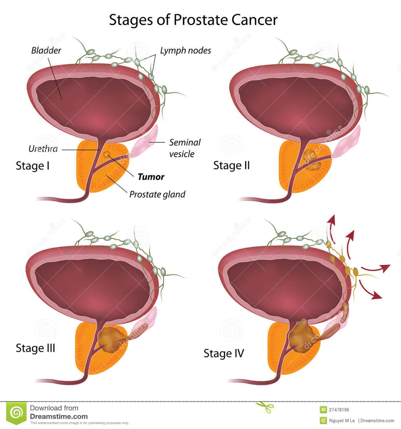 Stages of prostate cancer stock vector. Illustration of human