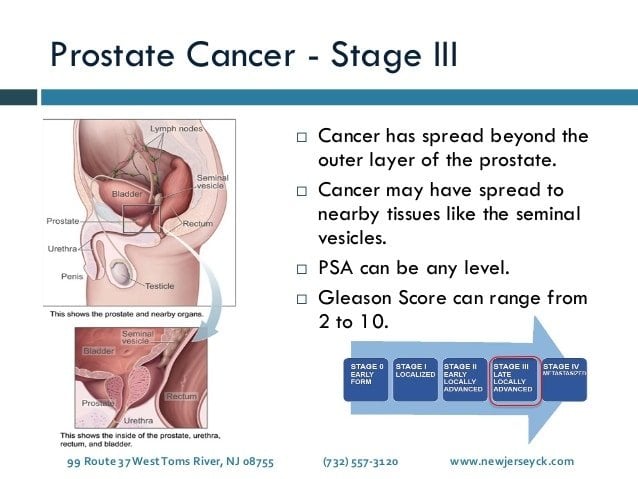 Stages of Prostate Cancer