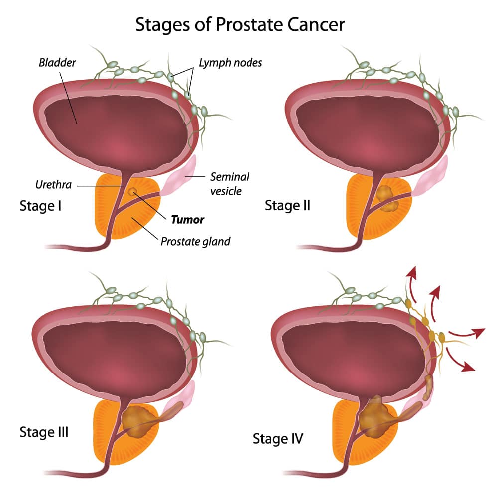 Staging Of Prostate Cancer
