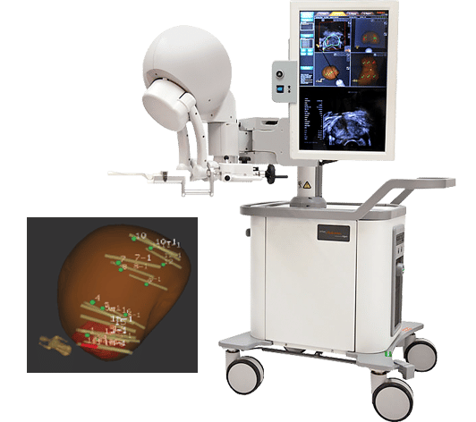 Targeted Prostate Biopsy with Artemis Fusion