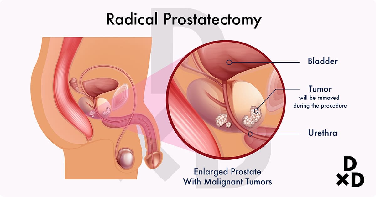The Ultimate Guide To Dealing With Prostate Cancer By A ...