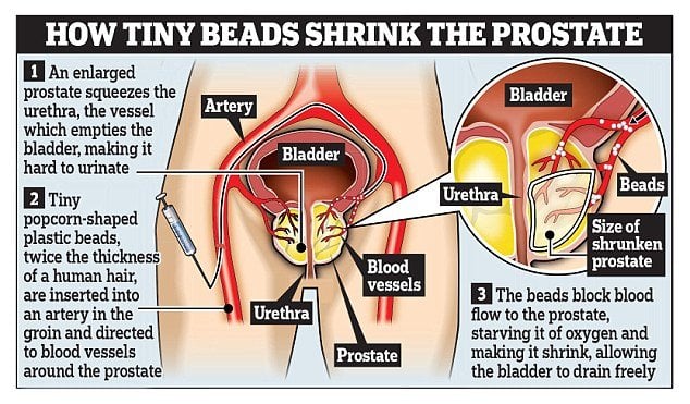 Thousands of men to benefit from new prostate therapy ...