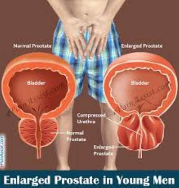 Treatment And Prevention Of Prostrate In Men From The Expert