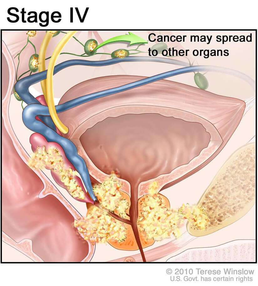 Treatment Stage 4 Prostate Cancer