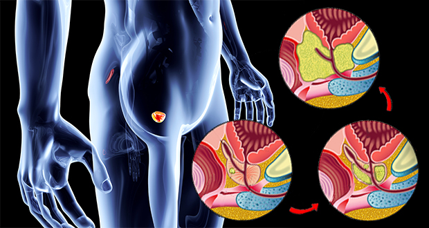 Understanding Symptoms of Prostate Cancer