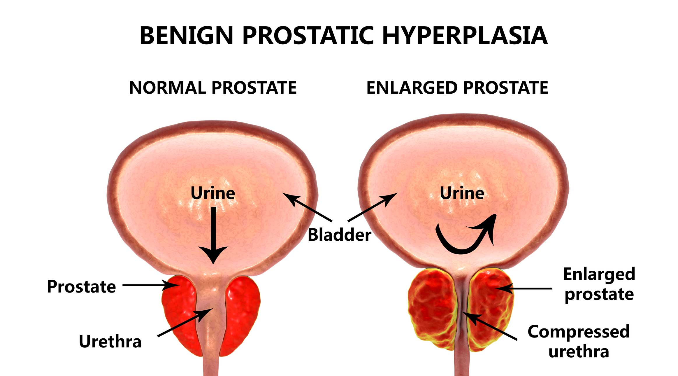 UroLift: New Relief From Enlarged Prostate
