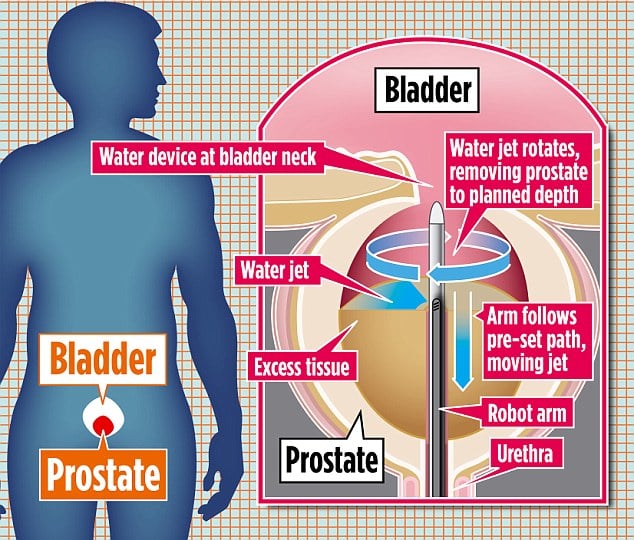 Water jet that washes away prostate problem could make frequent dashes ...