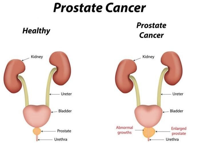 What are the early signs of prostate cancer?