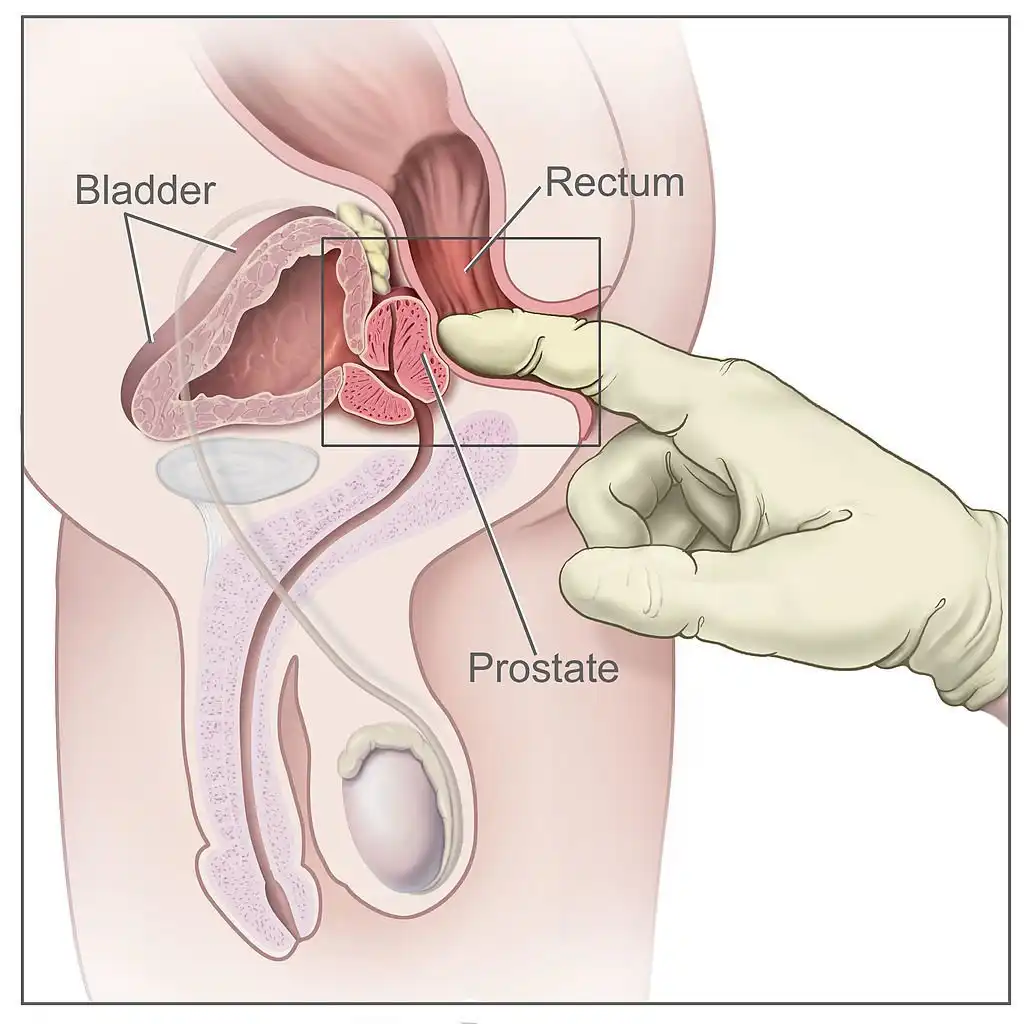 What Does An Infected Prostate Feel Like
