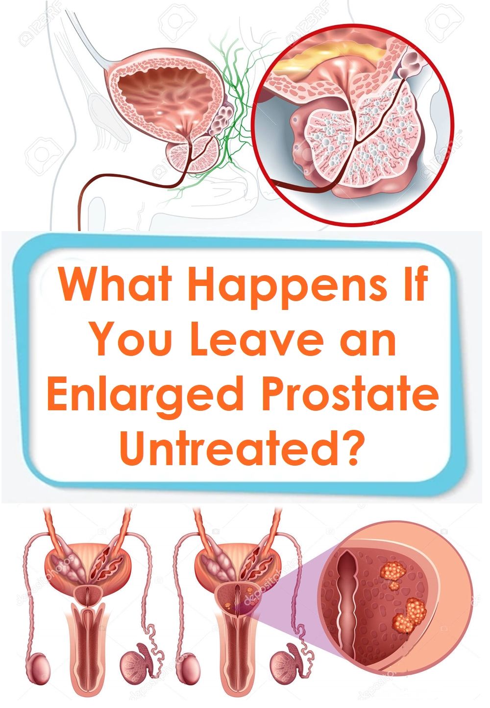 What Happens If You Leave an Enlarged Prostate Untreated ...