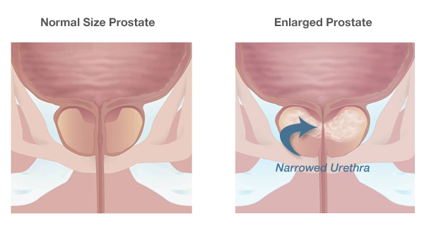 What is Enlarged Prostate? What is BPH (Benign Prostatic Hyperplasia)