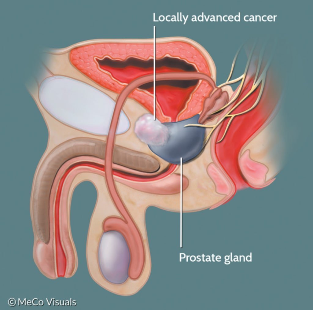 What is Localized or Locally Advanced Prostate Cancer?