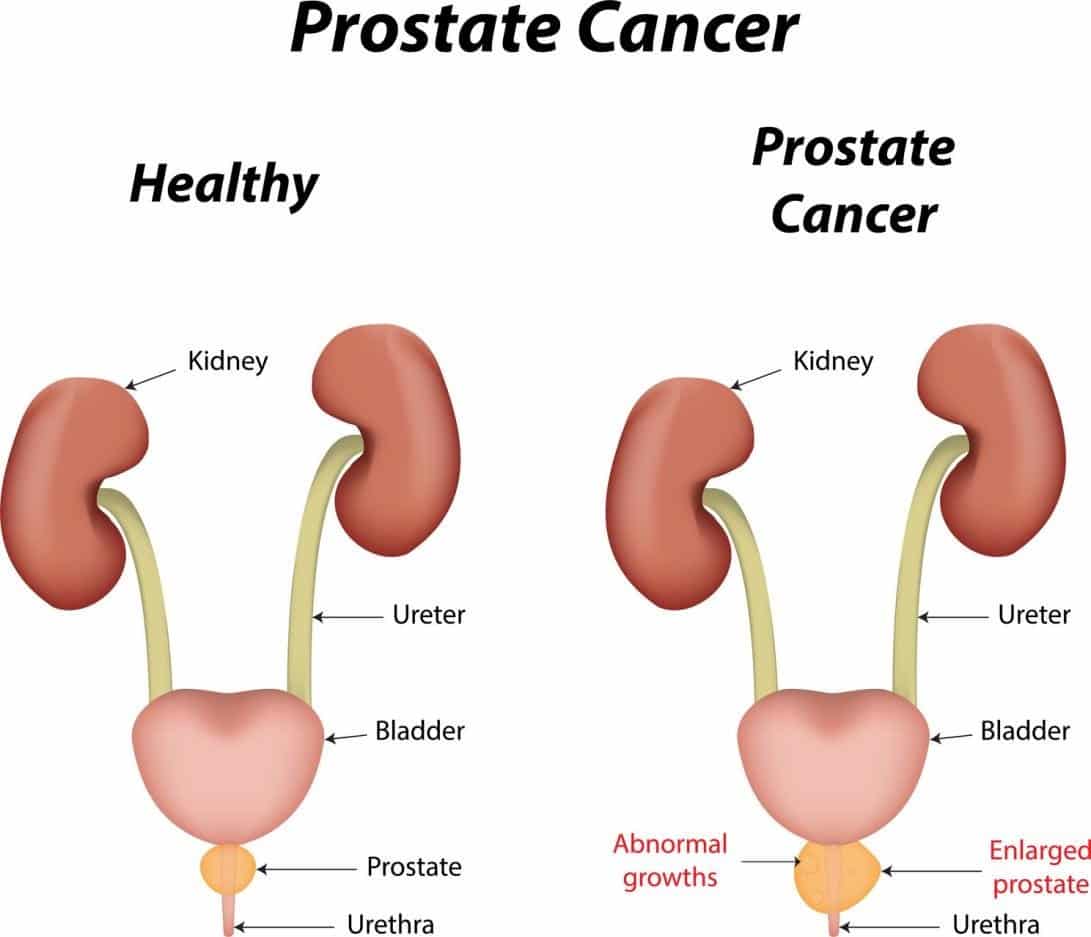 What Is The Test For Prostate Cancer Called